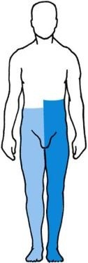injury to one-half of the cord, causing contralateral loss of pain and temp
the ipsilateral side side of the lesion has paralysis and loss of vibration and touch sensation