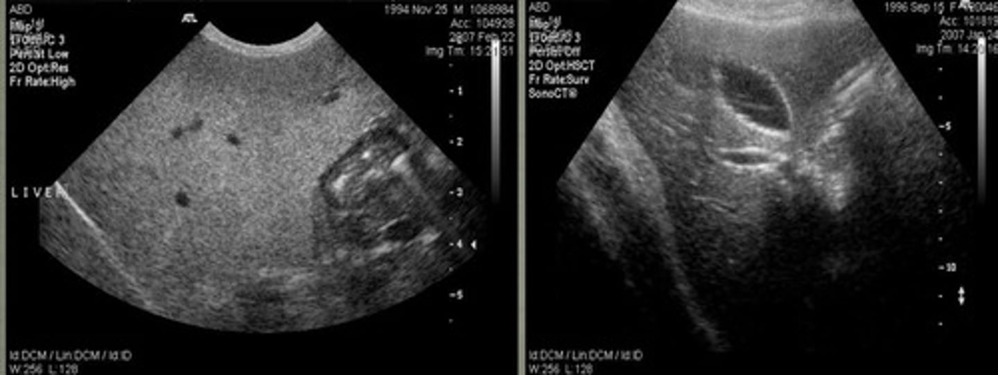 <p>which US image shows the normal liver?</p>