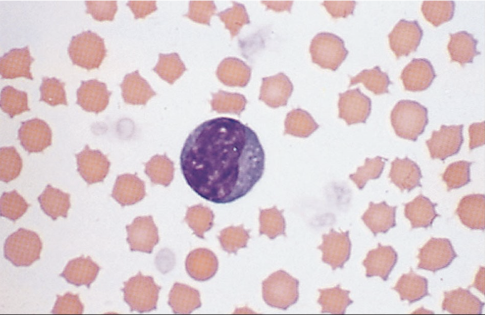 <p><span style="font-family: Lato Extended, Lato, Helvetica Neue, Helvetica, Arial, sans-serif">The nucleated basophilic staining cell below is most likely a</span></p>