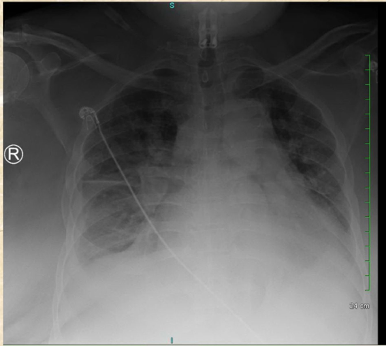<p>What does this CXR show (2 things)?</p>