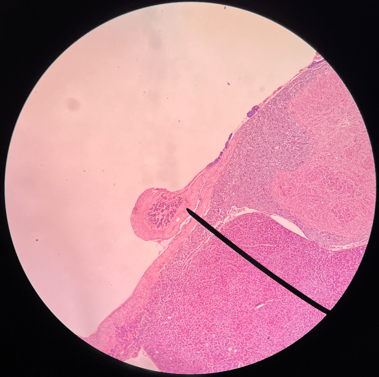 The narrow stalk attaching the hypophysis to the hypothalamus.
