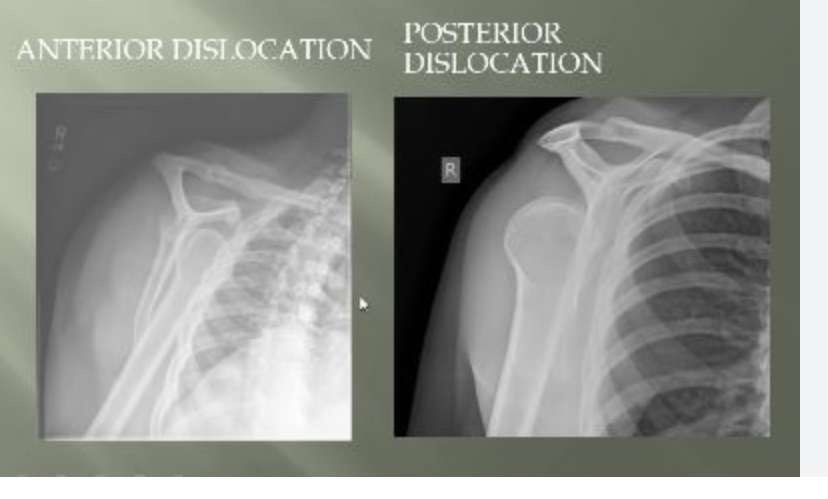 <p><span><span>when bones at a joint separate from their normal positions, often caused by trauma, leading to intense pain, swelling, deformity, and inability to move the joint</span></span></p>