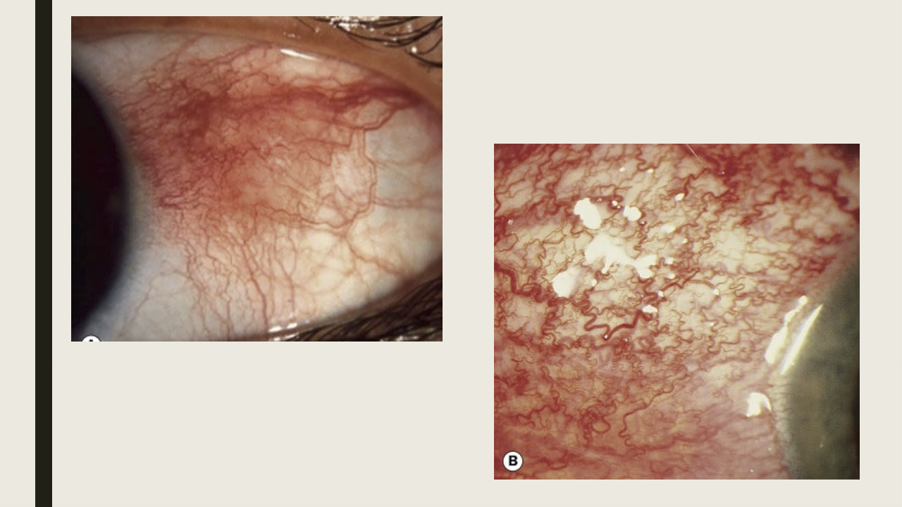 <p>Sectoral or diffuse interpalpebral redness that peaks about 12 hours after onset and lasts several days.</p>