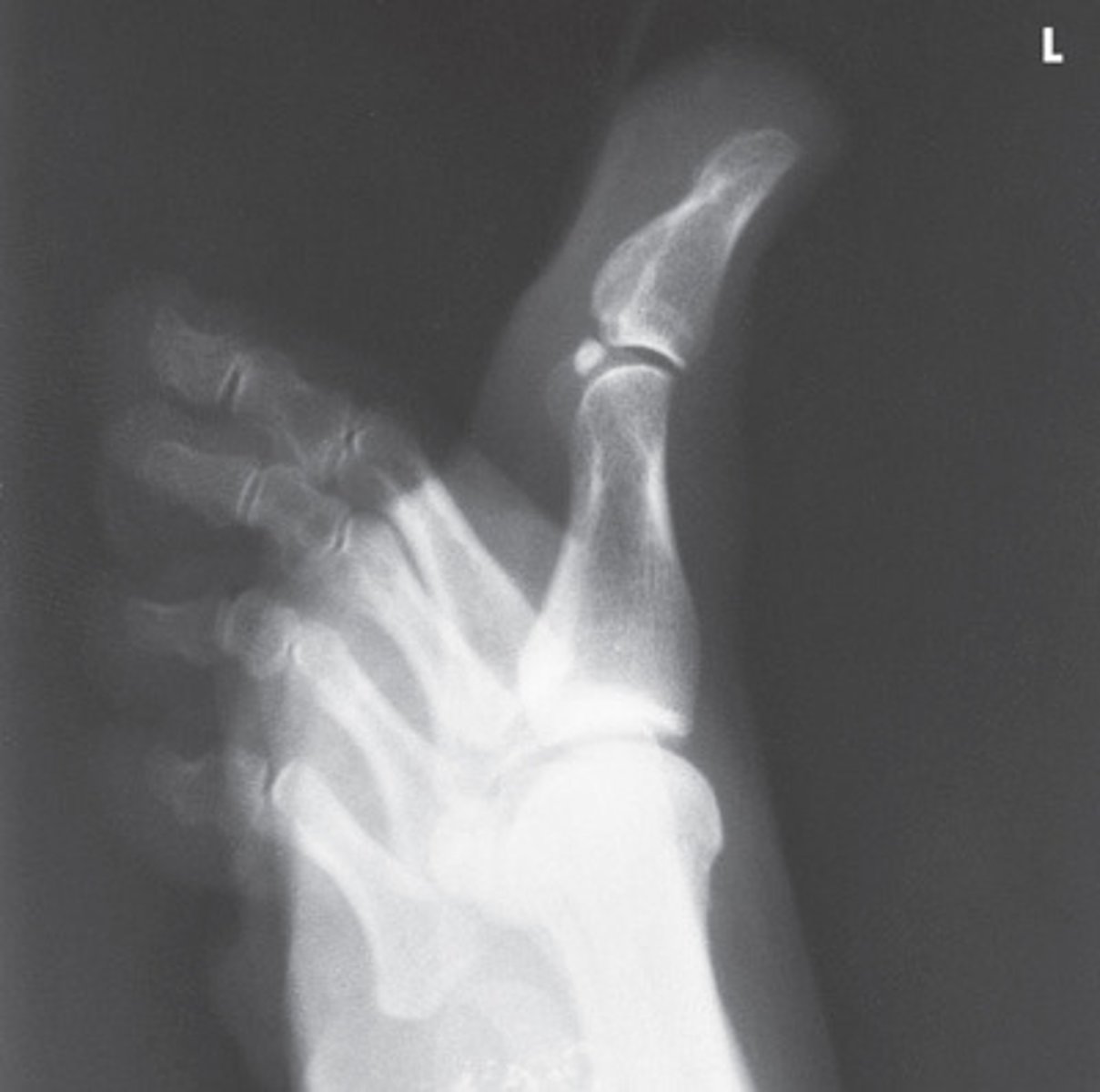 <p>- Lateromedial</p><p>- CR to IP</p><p>- Digits presented in true lateral position</p><p>- IP and MTP joints appear open</p><p>- Digit free of superimposition</p><p>- Optimal exposure factors</p>