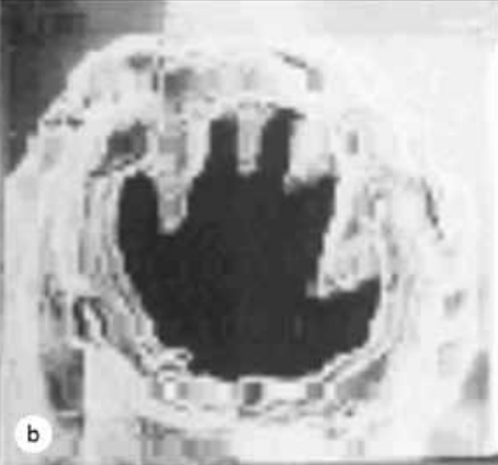 The buccal capsule of Ancylostoma duodenale has two pairs of 
