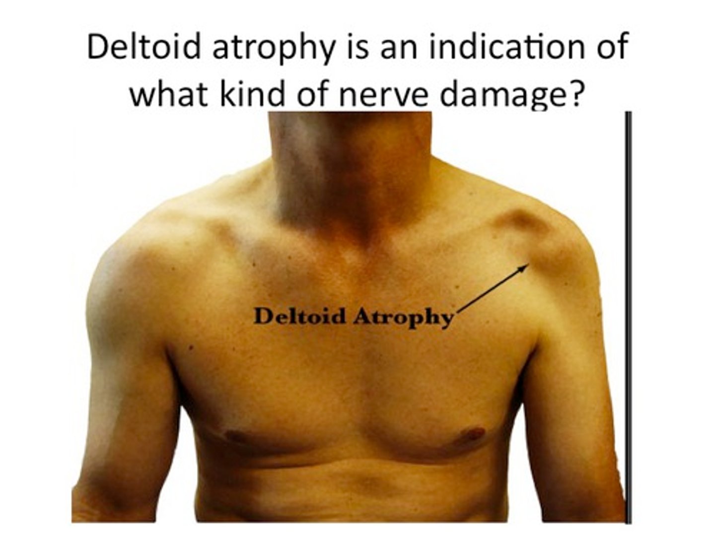<p>The axillary nerve can become damaged when the shoulder dislocates</p><p>Damage to the axillary nerve leads to weak abduction (deltoid) and weak external rotation (teres minor).</p>