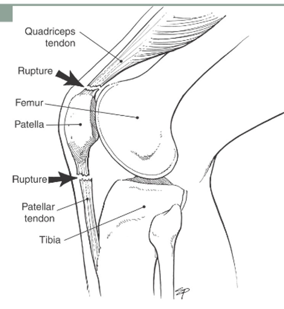 <p>jumping/kicking (overuse/overload)</p><p>"jumper's knee"</p>