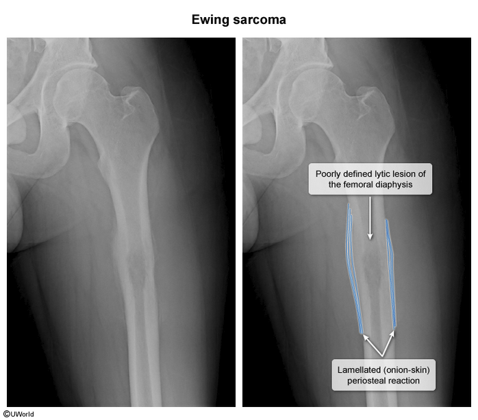 <p>ewing sarcoma </p>