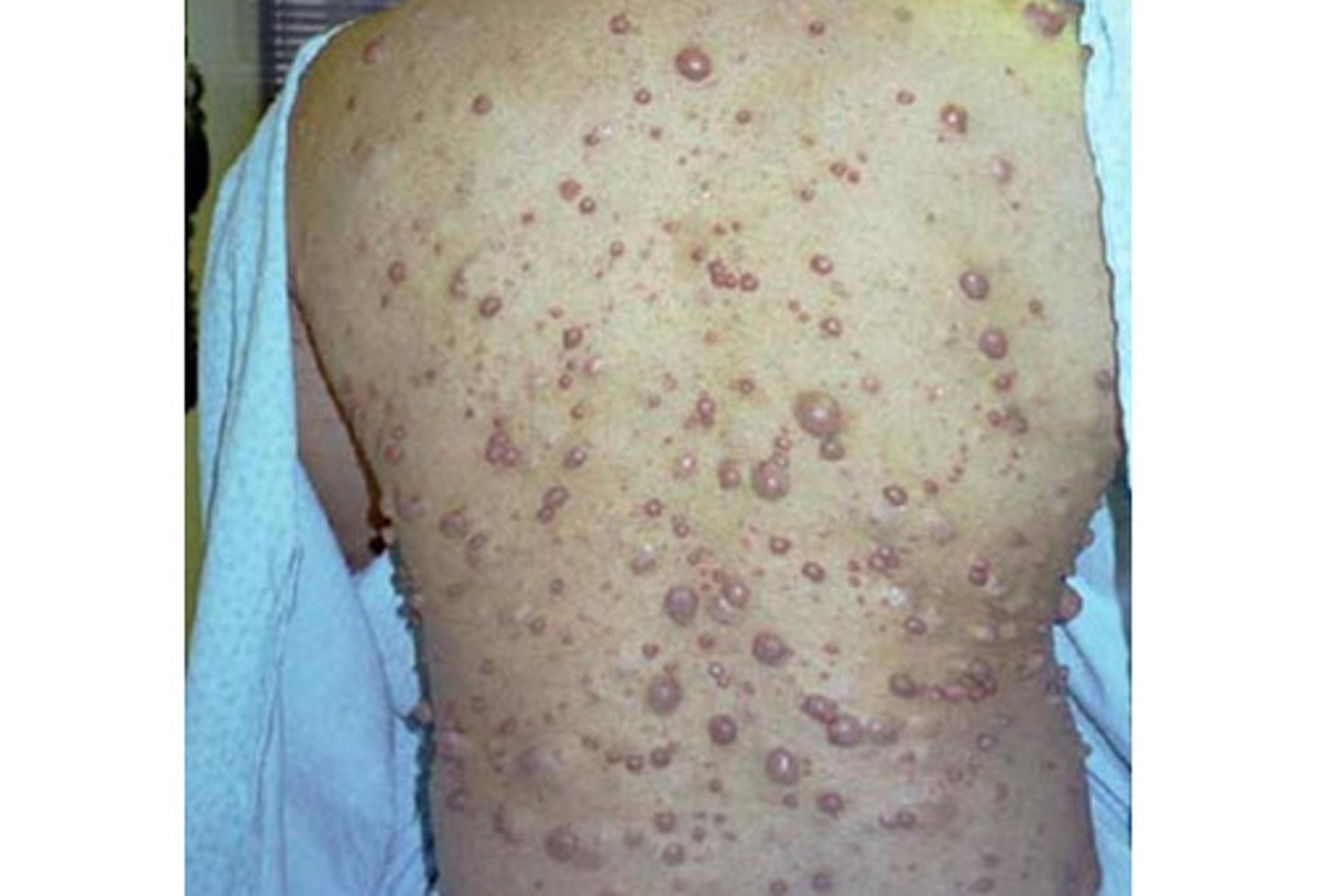 <p>cuatenous lesions are?</p>