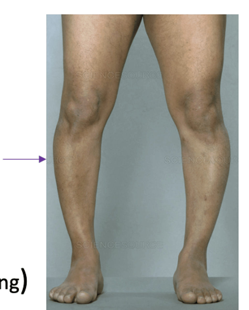 <p>Softening of bone in adults due to inadequate mineralization</p><p>Two main causes</p><p>(1)Insufficient calcium absorption from the intestine or vitamin D deficiency (most common)</p><p>(2)Phosphate deficiency due to increased renal losses or decreased intestinal absorption</p><p>Risk factors:</p><p>- Elderly (deficient diets &amp; malabsorption)</p><p>- Long-term anticonvulsant or diauretic treatment</p><p>Results in:</p><p>- Bone pain &amp; tenderness</p><p>- Fractures</p><p>- Deformities (gravity, muscle weakness, bone softening)</p>