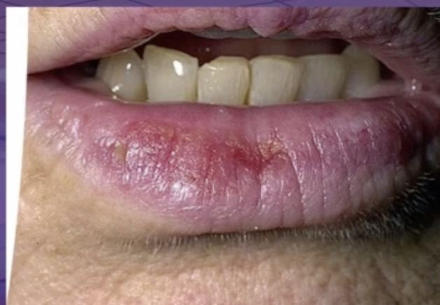 <p>what is the best management </p><p>prescribe antifungal ointment </p><p>surgical removal </p><p>observation </p><p>incisional biopsy </p>