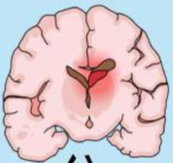 <p>Type of Hemorrhagic stroke with bleeding into the brain parenchyma. Secondary headache</p>