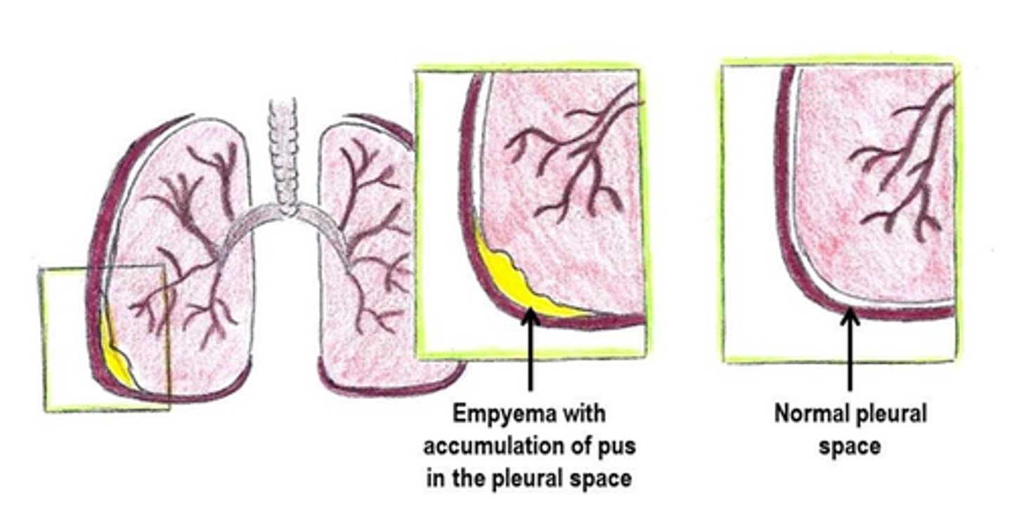 <p>pus in the chest cavity (pleural space) (also called empyema)</p>