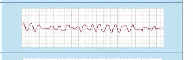 <p>fib is flopping- squiggly lines </p>