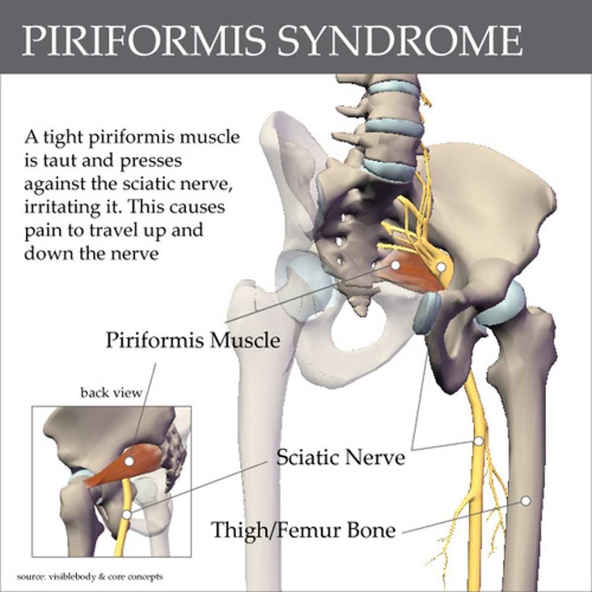 <p>Piriformis syndrome compresses what nerve?</p>