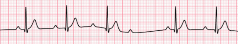 <p>Determine the A-V dysrhythmia (blocks):</p><ul><li><p style="text-align: justify;"><span>Increasing prolonged PR interval → Then drop</span></p></li><li><p style="text-align: justify;"><span>Rhythm is irregular, overall appearance of the rhythm demonstrates “group beating” </span></p></li><li><p style="text-align: justify;"><span>P waves are normal, some P waves are not conducted to the ventricles, but only one at a time fails to conduct to the ventricle</span></p></li><li><p style="text-align: justify;"><span>PR interval gradually lengthens in consecutive beats. The PR interval preceding the pause is longer than that following the pause </span></p></li></ul><p></p>