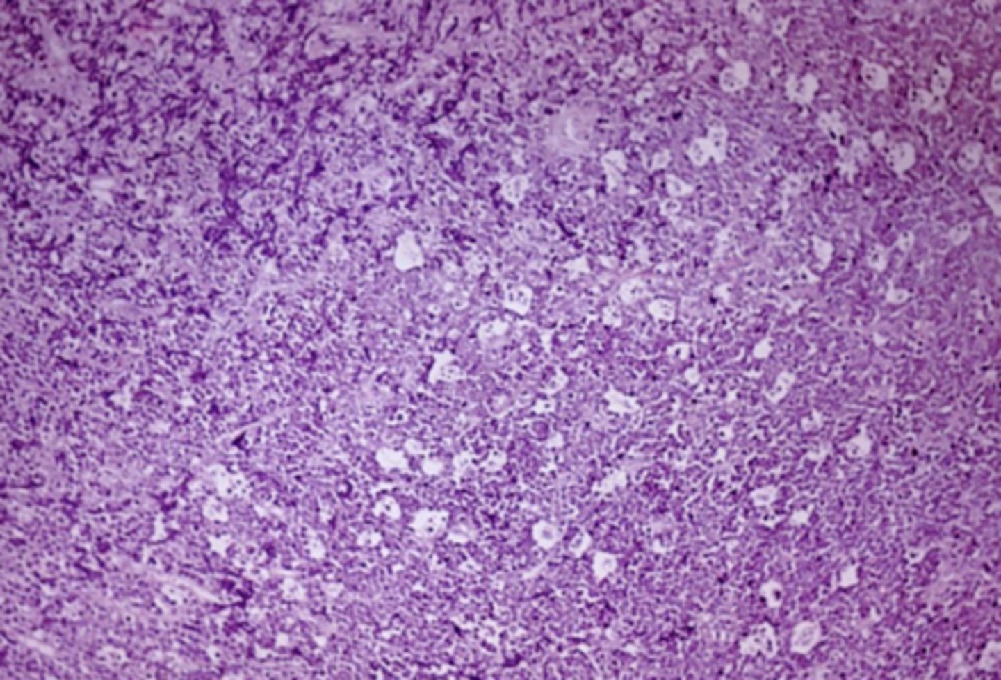 <p>Starry sky appearance</p><p>- mitotically active</p><p>- small lymphocytes are dark and many mitoses</p>