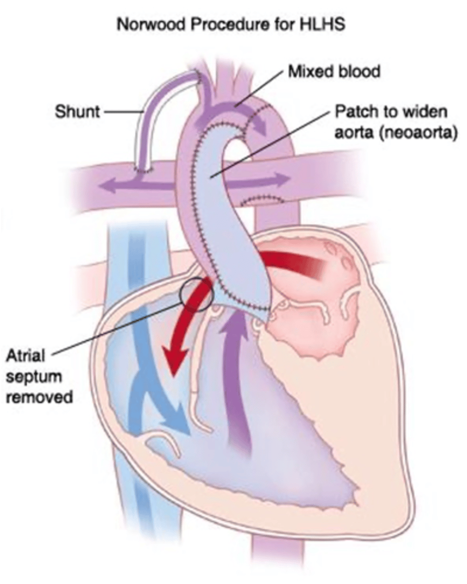 <p>1st stage of HLHS correction; pulmonary trunk is cut &amp; used to thicken the aorta &amp; attach it to the RV. This provides blood flow to the body but leaves the pulmonary arteries "floating in space." This is fixed by placing a shunt from the subclavian artery to the pulmonary arteries, restoring blood flow to the lungs</p>