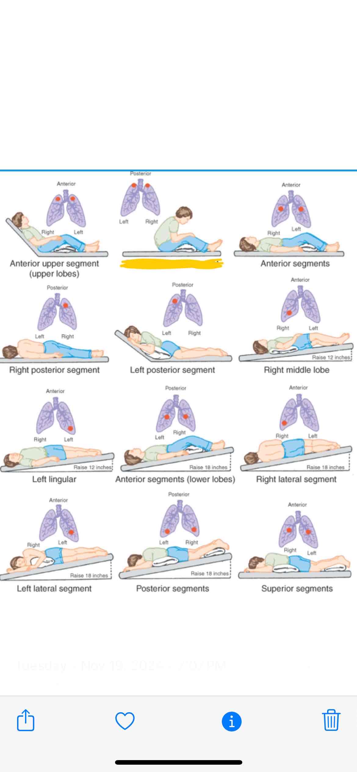 <p><span>Which lung segment does this position effect</span></p>