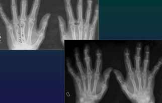 <p>Polyarthrosis (DIPh, Trapezo MC1)</p>
