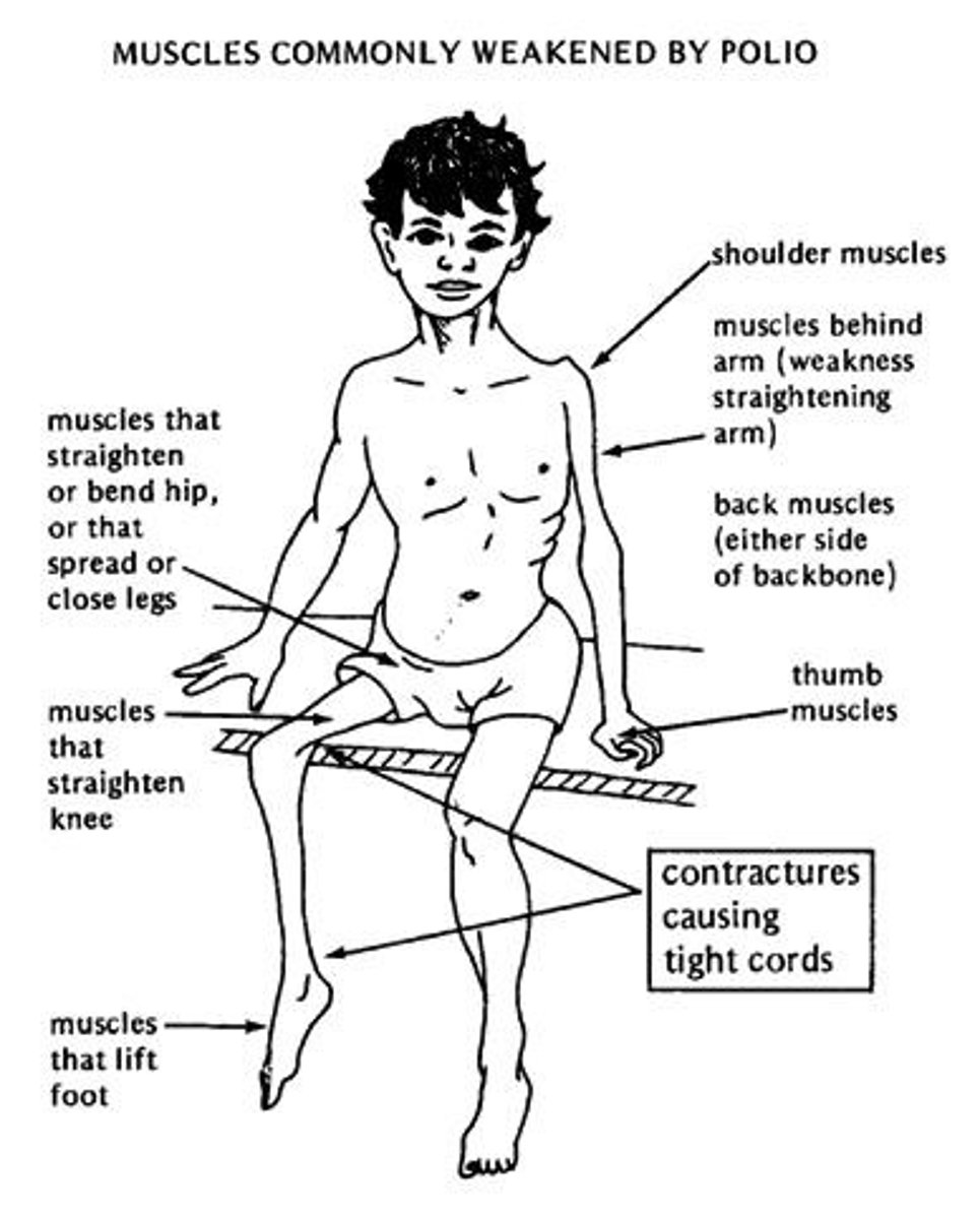<p>A. CORRECT. The polio virus affected thousands of people in the U.S. A vaccine was developed in 1952 that greatly reduced the incidence of the disease on a national scale.</p><p>B. Measles presents with fever, nasal discharge, rash, and red eyes. A vaccine series is readily available.</p><p>C. Rubella presents with rash and swollen lymph glands. A vaccine series is readily available.</p><p>D. Rabies presents with fever, throat spasms, profuse salivation, and uncontrollable excitement. Av accine series is readily available for humans and animals.</p>