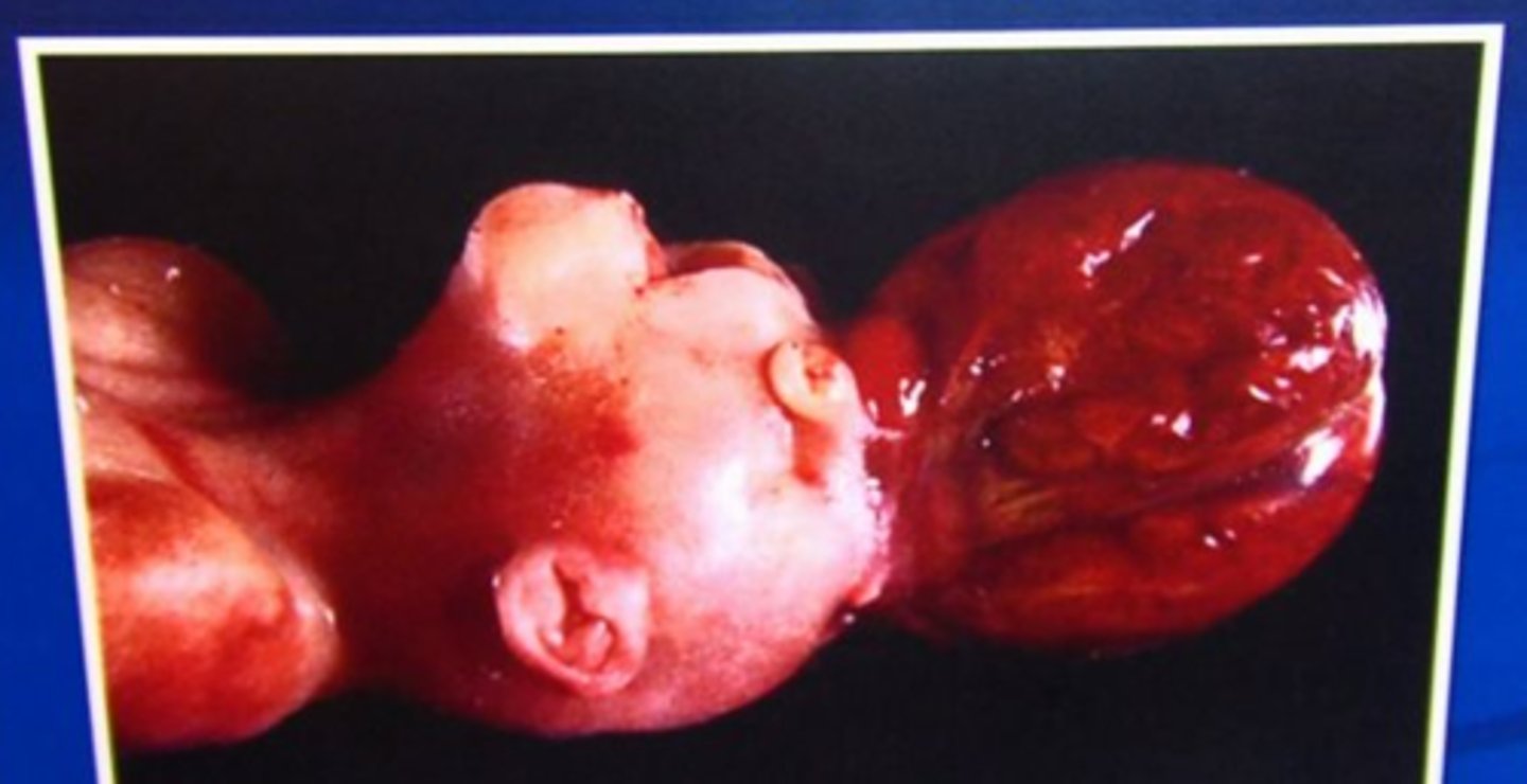 <p>Brain is totally exposed or extruded through an associated skull defect; fetus usually aborted</p>