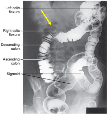<p>Barium Enema: Identify the Position</p>