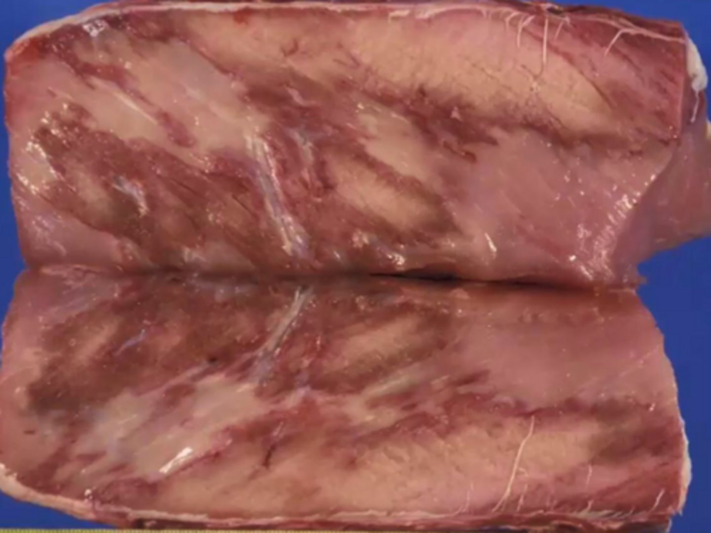 <p>What is malignant hyperthermia?</p>