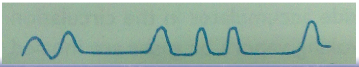 <p>Biot</p><p><em>Damage or pressure to the medulla oblongata due to a hemorrhage, tumor, or traumatic causes.</em></p>