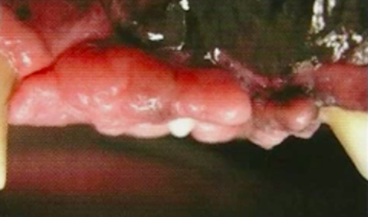 <p>overgrowth of gum tissue. Often seen in boxers.</p>
