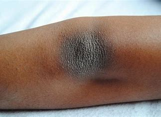 <p>A dark-skinned pt. has dry/ashy skin. Is this patient necessarily dehydrated?</p>