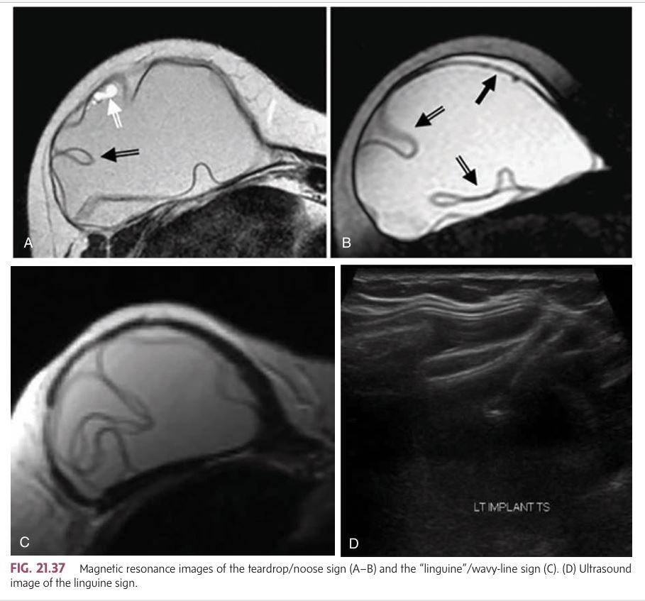 <p>intracapsular silicone rupture include the _____ on MRI</p>