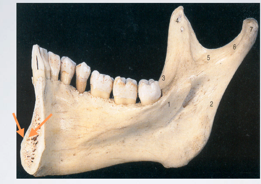 <ul><li><p>the density of the cortical plate of the mandibular bone</p></li><li><p>It precludes the successful administration of supraperiosteal anesthesia</p></li></ul><p></p>