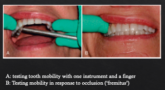 <p>by moving the crown in a bucco-lingual direction with two instruments or with one instrument and a finger</p>