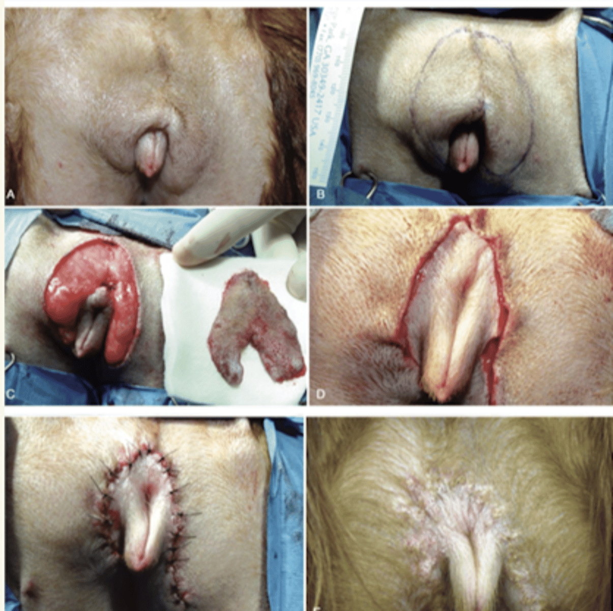 <p>episioplastia</p>