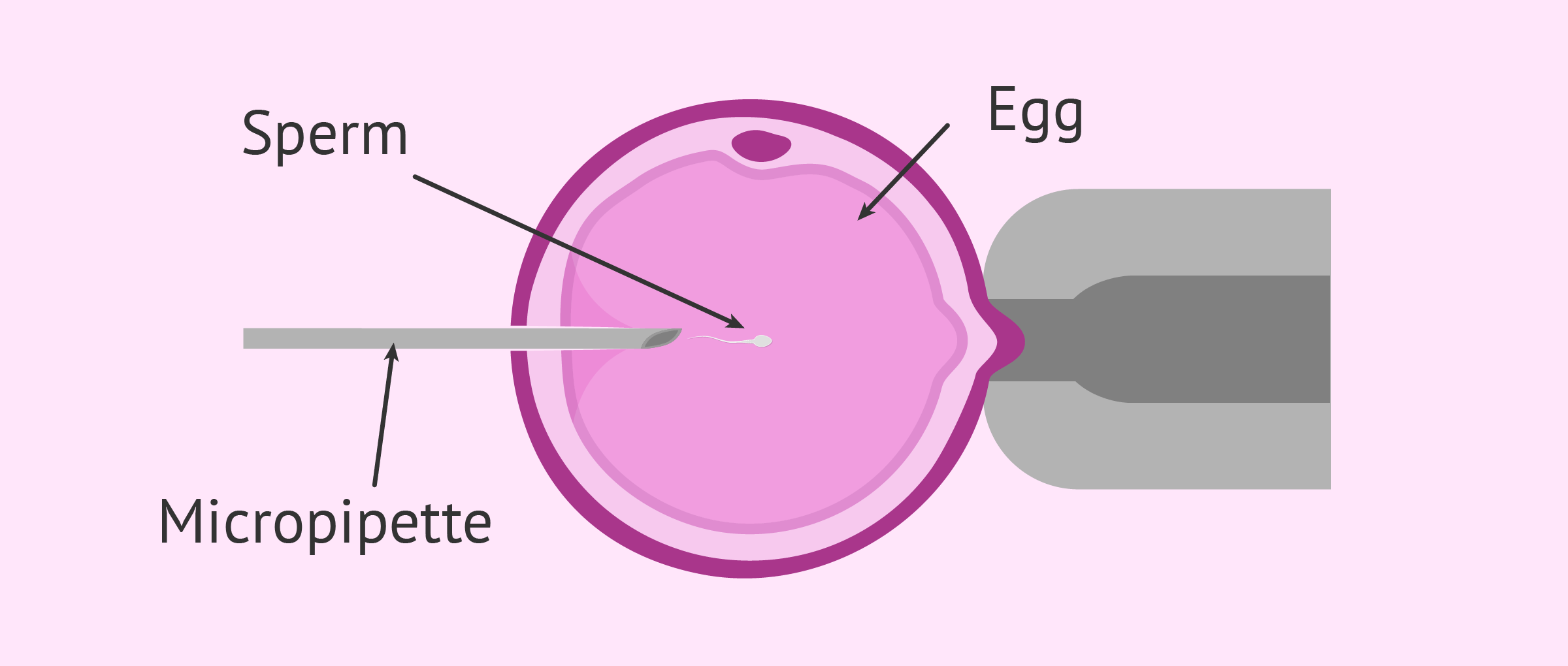 <p>The head of a sperm is drawn into a needle and injected directly into the egg to achieve fertilisation.</p>