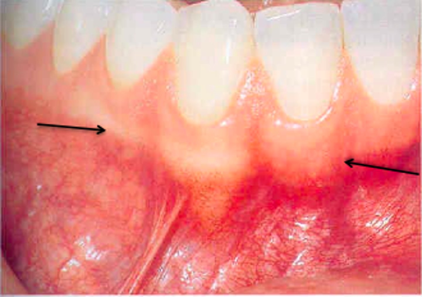 <p>The point where the gingiva becomes tightly attached to the bone.</p>