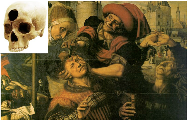 <ul><li><p>Release of demons</p></li><li><p>Belief that mental disorders due to evil spirits, etc.</p></li></ul><p></p>