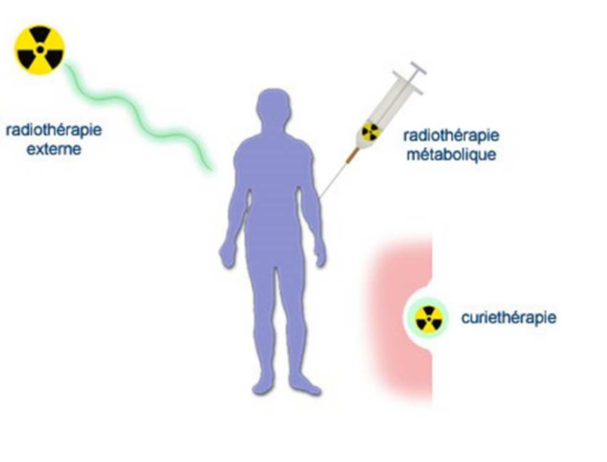 <ul><li><p><span style="color: red"><strong><u>Curithérapie</u></strong></span> : Technique d’irradiation qui consiste à introduire directement dans l’organisme des sources radioactives scellées</p><p></p></li><li><p><span style="color: red"><strong><u>Radiothérapie externe </u></strong></span>: Technique d’irradiation (générateur de rayons qui irradient le patient)</p><p></p></li><li><p><span style="color: red"><strong><u>Radiothérapie interne (« vectorisée ») ou RT</u></strong></span></p><p><span style="color: red"><strong><u>métabolique :</u></strong></span> Injection d’un médicament radioactif (MRP) qui va « cibler » les cellules cancéreuses</p></li></ul><p></p>