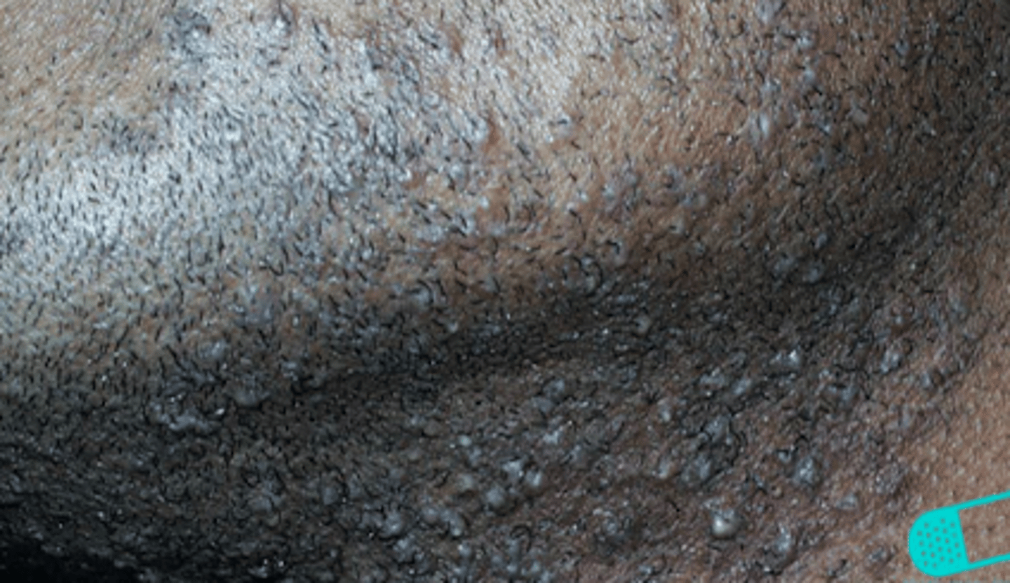 <p>Bacterial Skin Infections:</p><p>- aka <strong>razor bumps</strong></p><p>- foreign body inflammatory reaction<strong> surrounding ingrown hairs from shaving/plucking</strong></p><p>- can be seen in anyone but most commonly in black men</p>