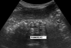 <p>heterogeneous</p><p>Hyperechoic with calcifications</p><p>Possible pseudocyst</p><p>Possible ductal dilatation</p>