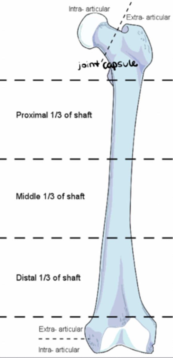 <p>Thirds of bone (middle, proximal, distal); intra- vs. extra-articular</p>