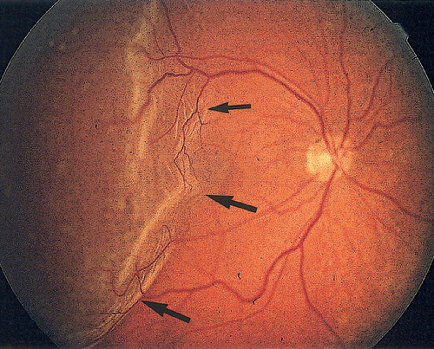 <p>Retinal detachment can occur spontaneously or secondary to myopia, trauma, or inflammatory changes within the eye.</p>