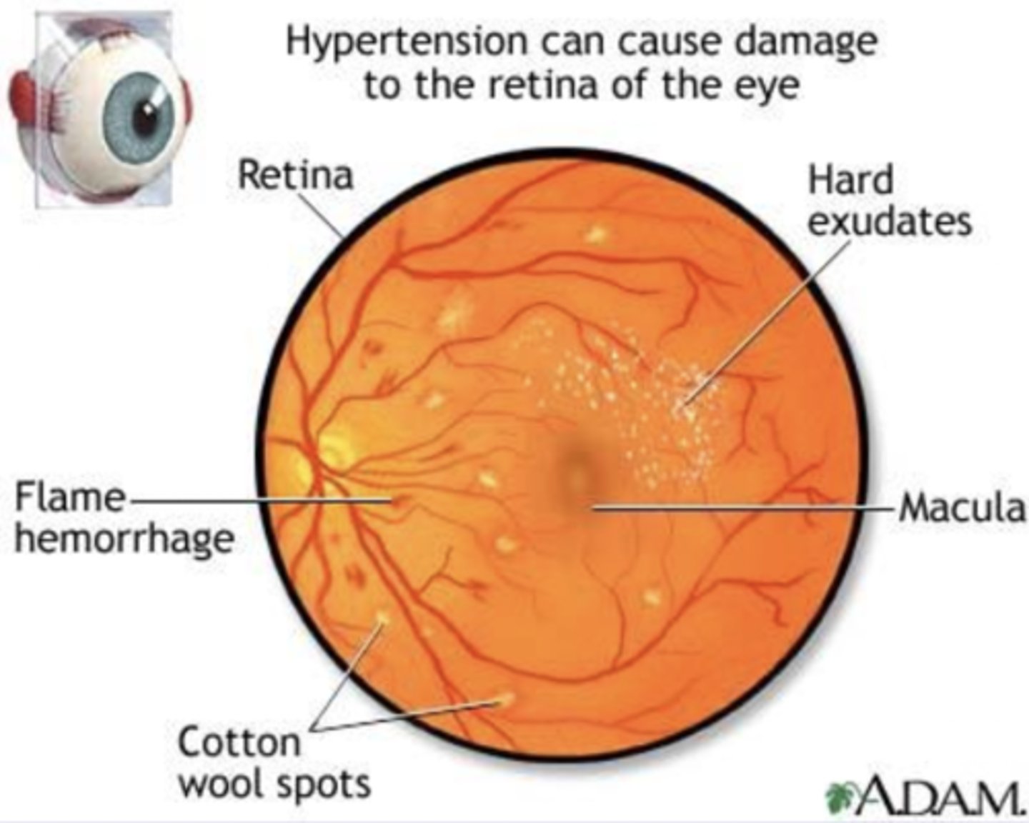 <p>Hypertensive retinopathy is caused by vasoconstriction, arteriosclerosis, and increased vascular permeability due to hypertension, which leads to breakdown of the inner blood-retinal barrier.</p>