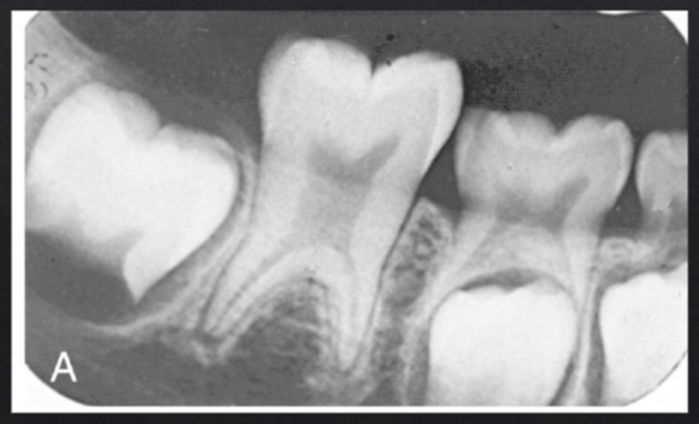 <p>Tooth with elongated pulp chamber and shortened roots, normal crown presentation</p>
