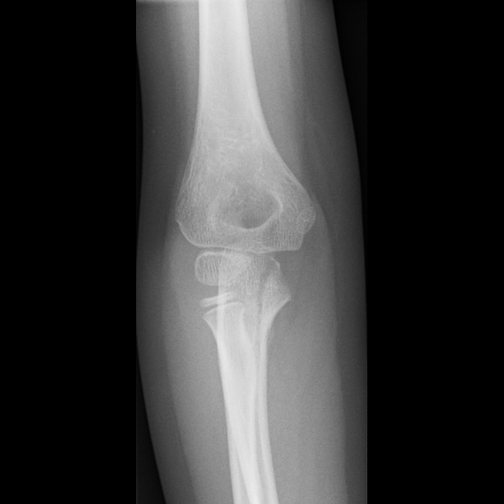 a fracture that runs parallel to the long axis of the bone

