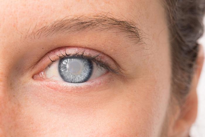 clouding of lens; oxidation of crystallin proteins--blocks light from coming through

caused by age, diabetes, smoking, intense light, ionizing radiation
