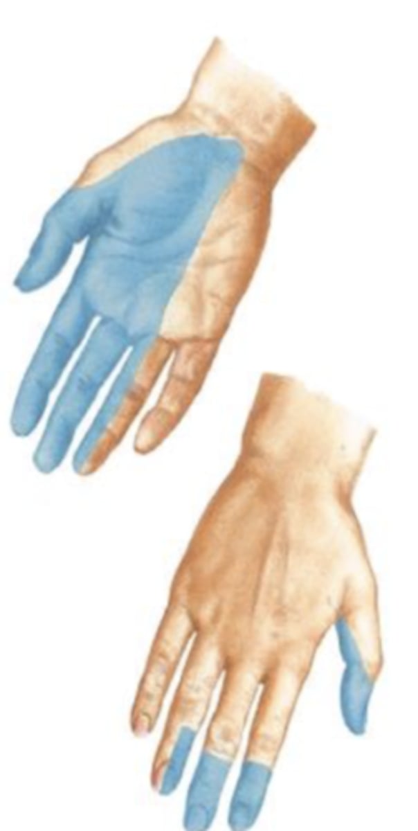 <p>- Motor to pronator teres, flexor carpi radialis, palmaris longus, flexor digitorum superficialis, flexor digitorum profundus (1/2), pronator quadratus, thenar muscles, and 2 lumbricals.</p><p>- Sensory from skin of lateral palm, thumb, index finger, middle finger and ½ of ring finger.</p><p>- Most noticeable weakness with damage: flexion of the wrist and fingers; pronation.</p>