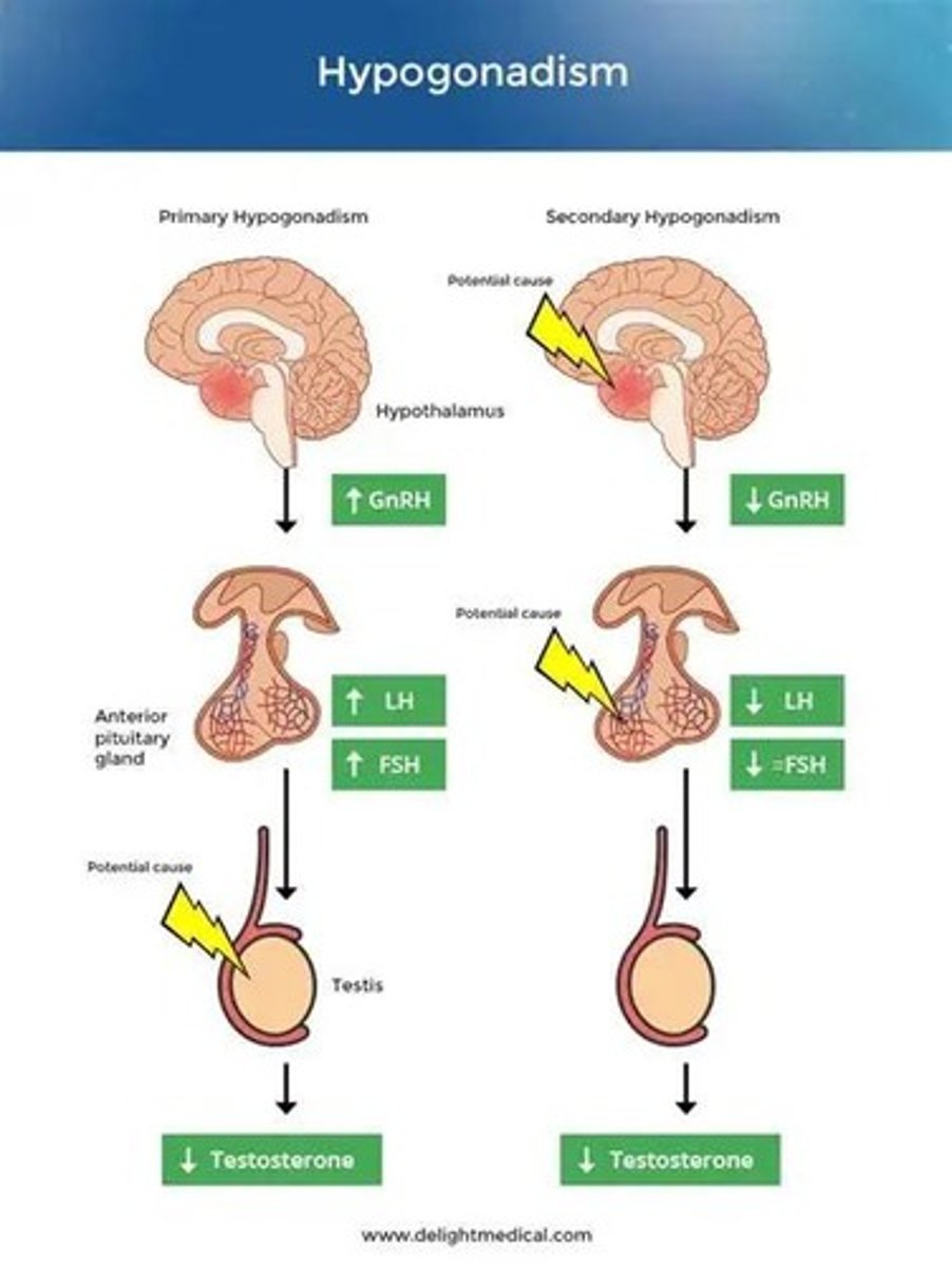 <p>Hypergonadotropic hypogonadism is characterized by high levels of pituitary gonadotropins, while hypogonadotropic hypogonadism is due to insufficient secretion from the pituitary or hypothalamus.</p>