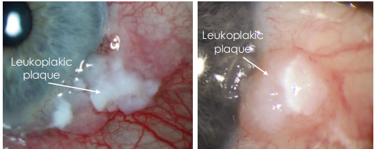 <p><strong><u>• Whitened and thickened surface with surface hyper -keratinization</u></strong></p>